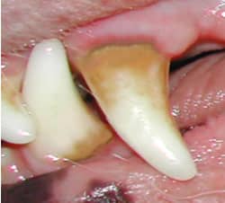 stage2 of moderate gingivitis w/ inflamed, swollen gums.